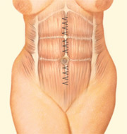 La musculatura y tejidos de la pared abdominal son aproximados para conseguir una cintura más estrecha y larga.