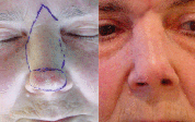 Extirpación de un tumor en punta nasal y reconstrucción mediante un colgajo.