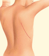 Reconstrucción mamaria mediante colgajo dorsal ancho. 
