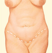 Antes de una abdominoplastia: la incisión se coloca sobre el área púbica para permitir extirpar el exceso de piel y grasa.