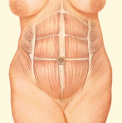 Antes de una abdominoplastia: musculatura de la pared abdominal.