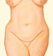 El exceso de piel es extirpado; en las abdominoplastias completas el ombligo es recolocado.