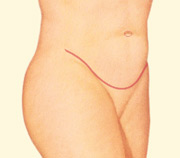 Después de una abdominoplastia: el abdomen es más plano y estrecho. Las cicatrices, aunque definitivas, se hacen menos visibles con el tiempo.