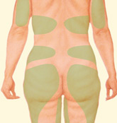 Las mujeres pueden someterse a una liposucción en la región de la papada, en las caderas, los muslos, el abdomen, debajo de los brazos y alrededor de la mama.
