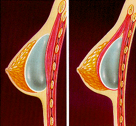 Colocación subglandular (izda.) y subpectoral (drcha.) de las prótesis mamarias.