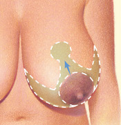 Diseño de la intervención y técnica quirúrgica. La areola es colocada en una posición más adecuada y el exceso de glándula mamaria es eliminado.
