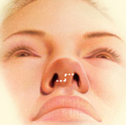 Las incisiones se realizan en el interior o en la base de la nariz, permitiendo remodelar los cartílagos y huesos de la nariz.